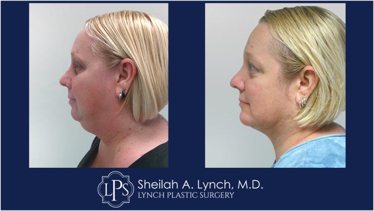 Neck Lift Before And After Images Neck Lift Surgeon Maryland