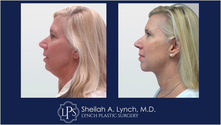 Neck Lift Patient 11 Before and After Images Maryland