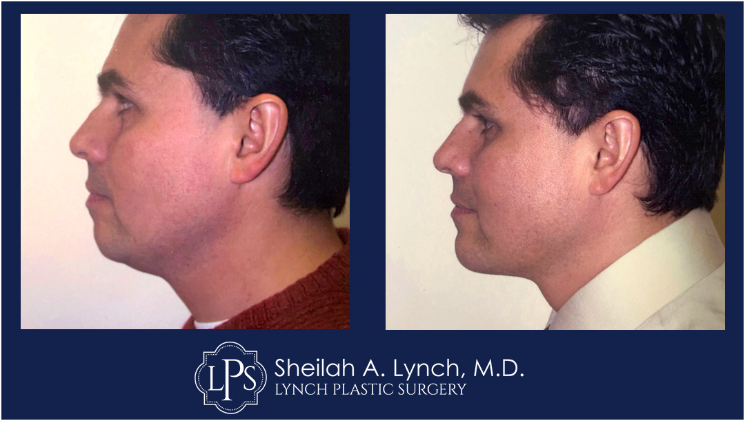 male chin implant neck lift before and after images easton maryland