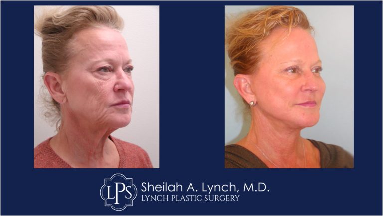 GONE - Sagging Facial & Neck Skin! See The Results! Neck Lift Before and After Images