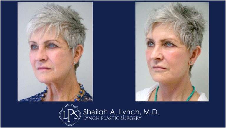 Neck lift before and after images maryland, work of leading facial plastic surgeon, Sheilah A. Lynch, MD