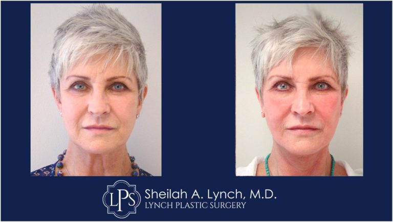 Neck Lift Patient 16 Before and After Images Easton