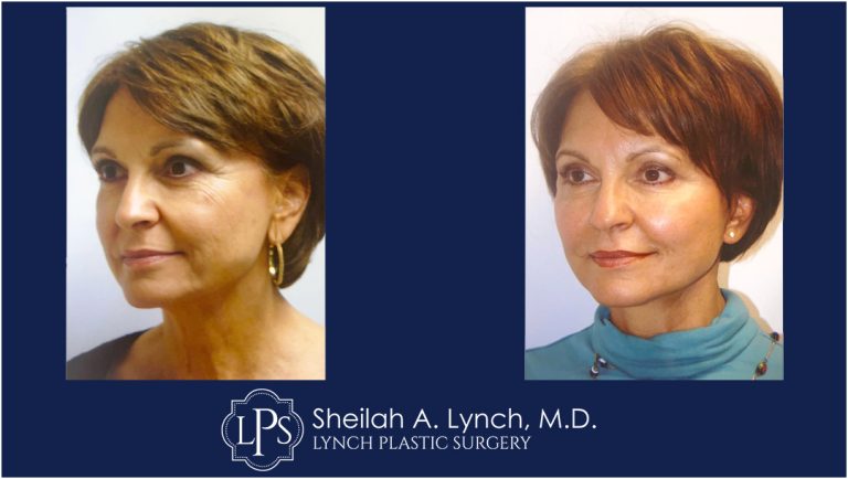 Neck Lift Patient 15 Neck Lift Before and After Images - Macs Lift
