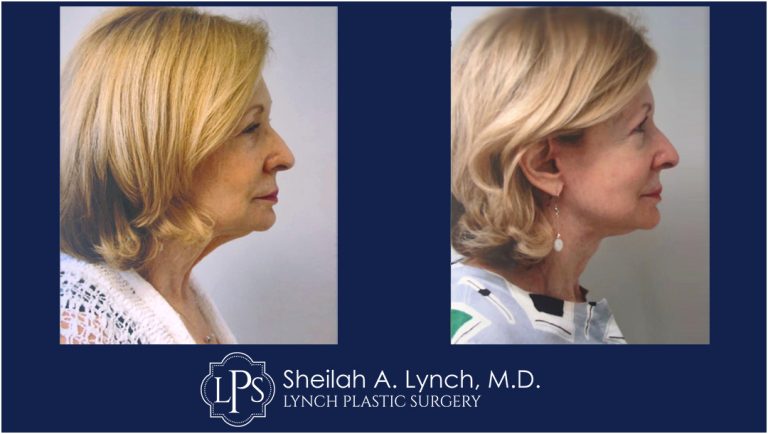 Neck Lift Patient 15 Before and After Images Easton