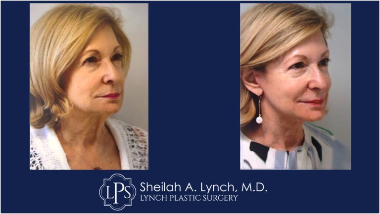 Neck Lift Patient 15 - Macs Lift Before After Images