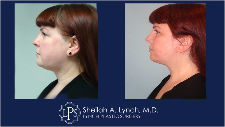 Lower Face Lift Before After Images - Photo Gallery