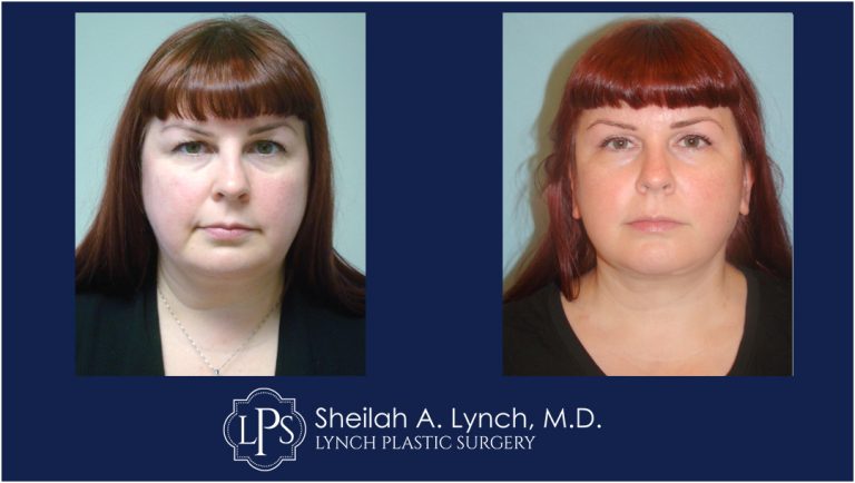 Neck Lift Patient 18 Before and After Images - Macs Lift