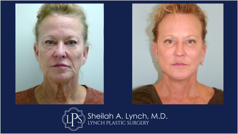 GONE - Sagging Facial & Neck Skin! See The Results! Neck Lift Before and After Images