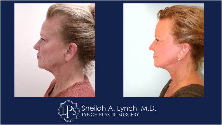 Neck Lift Patient 8 Before And After Images Neck Lift Surgeon Maryland