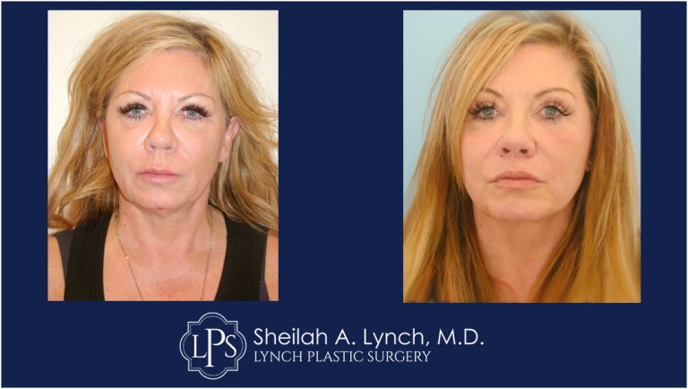 Neck Lift Patient 13 Before And After Images Neck Lift Surgeon Maryland