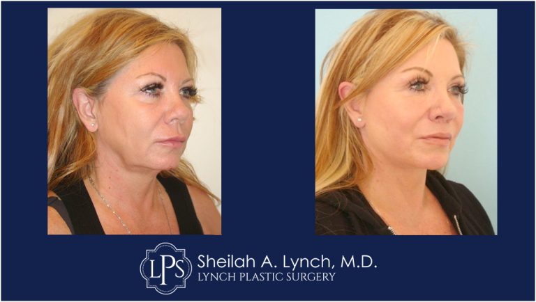 Neck Lift Patient 13 Before And After Images Neck Lift Surgeon Maryland