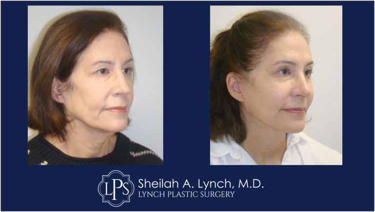 MACS Lift Patient 7 Before and After Images