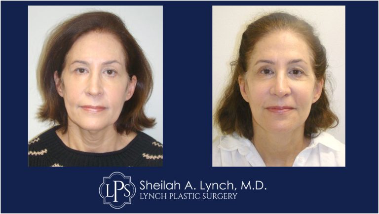 MACS Lift Patient 7 Before and After Images
