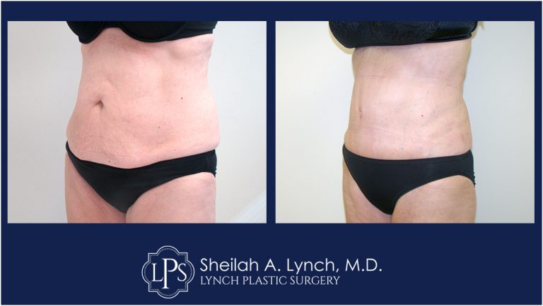 patient 15 Tummy Tuck 360 before and after images