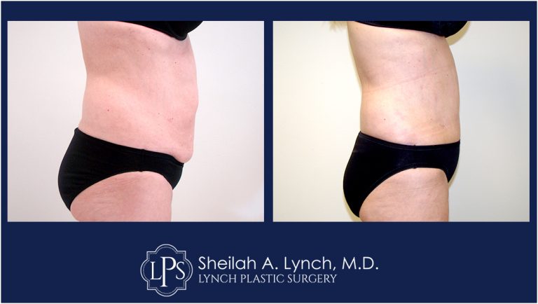 patient 15 Tummy Tuck 360 before and after images
