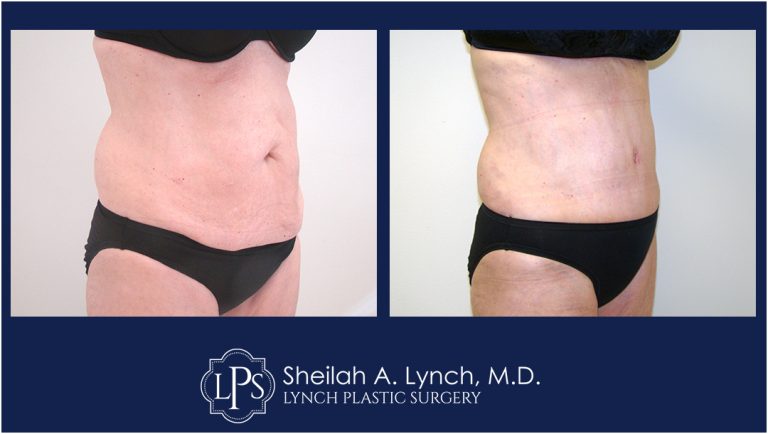 patient 15 Tummy Tuck 360 before and after images