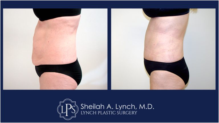 patient 15 Tummy Tuck 360 before and after images