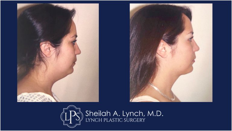 Facelift - Neck lift Before and After Images - Photo Gallery
