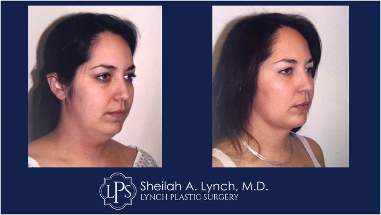 Neck Liposuction Patient 17 Before and After Images Easton Maryland - Macs Lift
