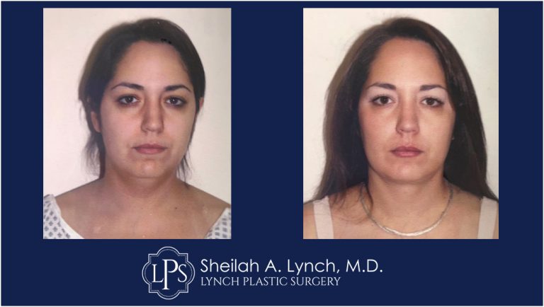 Neck Liposuction Patient 17 Before and After Images Easton Maryland - Macs Lift