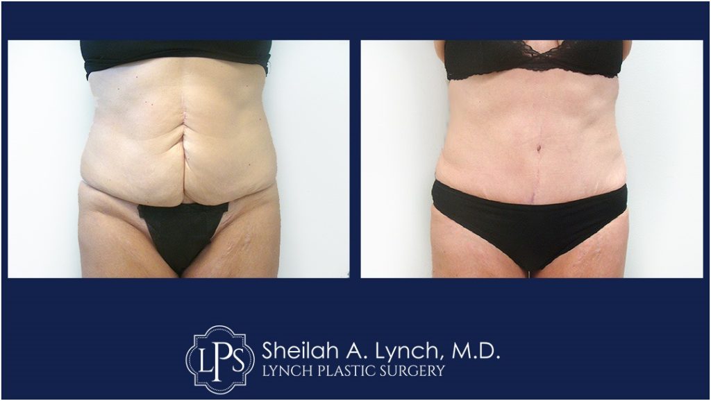 Patient 14 Tummy tuck Before & After Images