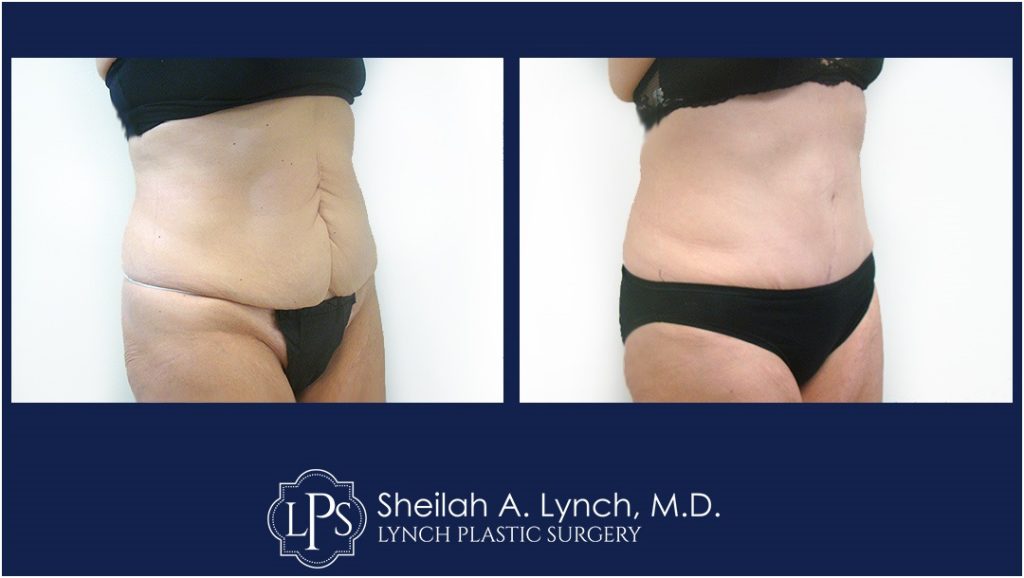 Patient 14 Tummy tuck Before & After Images