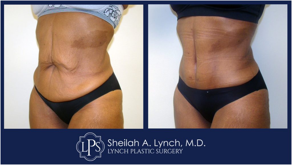 Patient 17 Tummy Tuck Scar Repair or Revision In Maryland