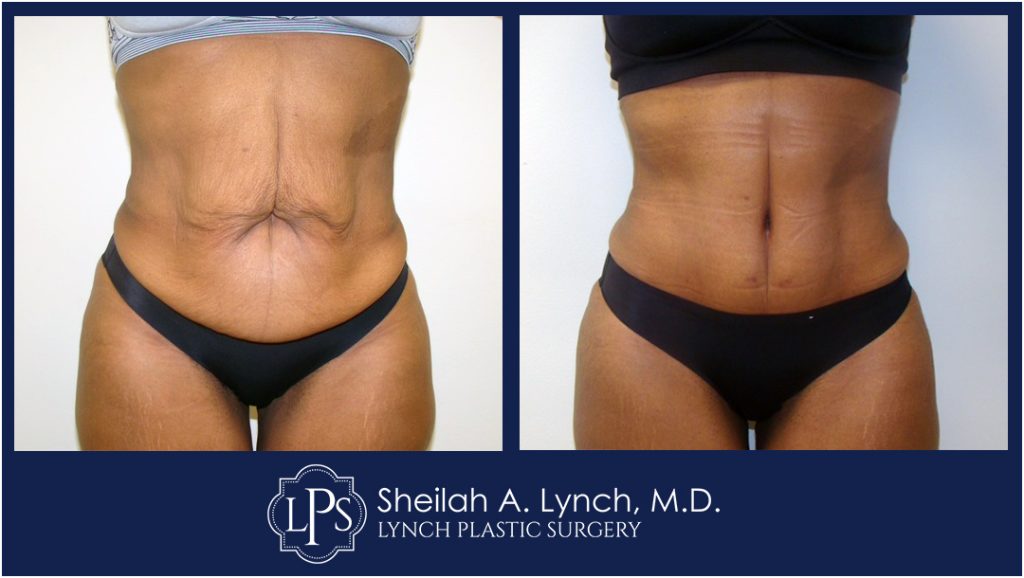 Patient 17 Tummy Tuck Scar Repair Patient Before After Image Tummy Tuck Surgery In Chevy Chase
