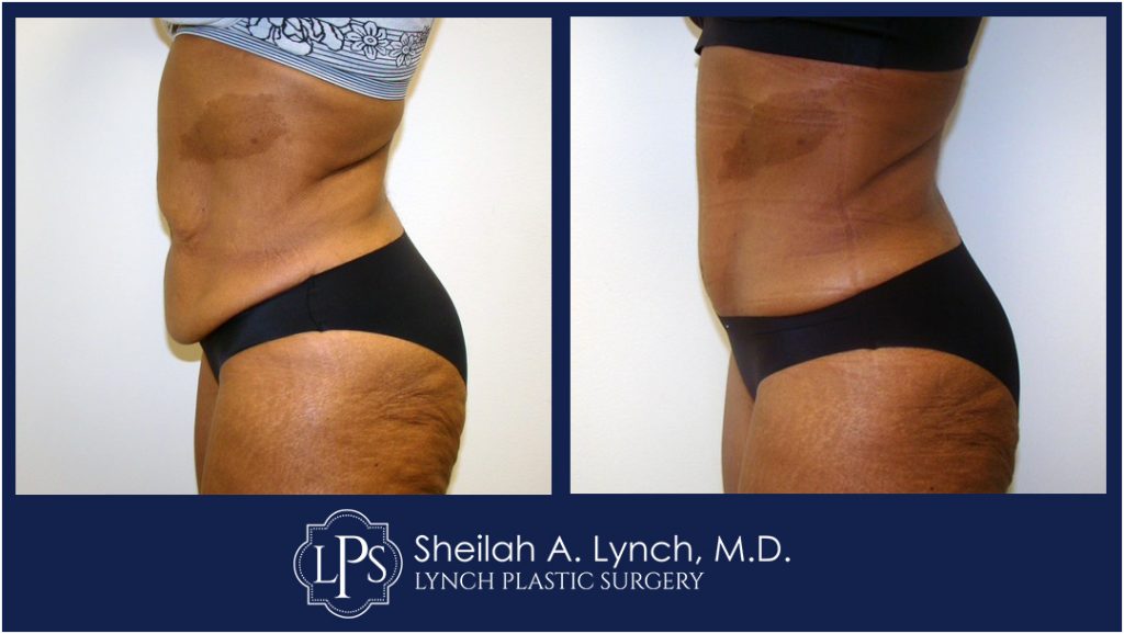 Patient 17 Tummy Tuck Scar Repair or Revision In Maryland