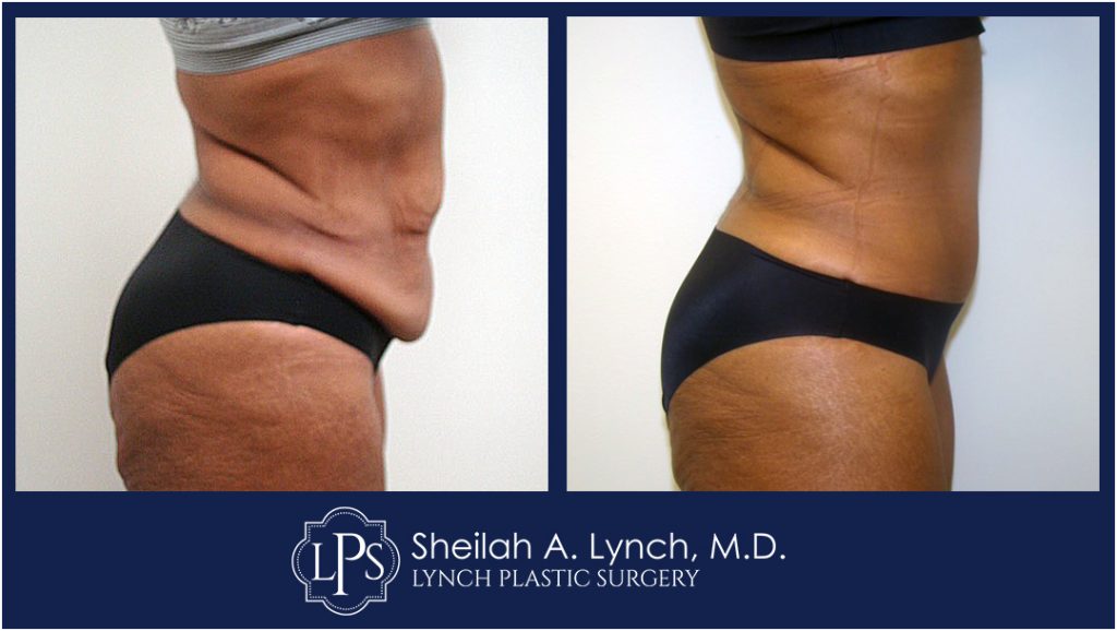 Patient 17 Tummy Tuck Scar Repair or Revision In Maryland