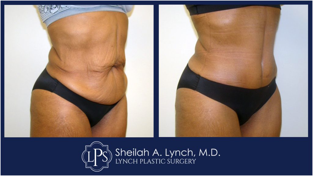 Patient 17 Tummy Tuck Scar Repair or Revision In Maryland