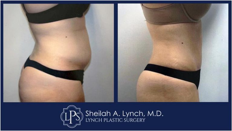 $500 Tummy Tuck Surgery Chevy Chase Patient 18 Before and After Images