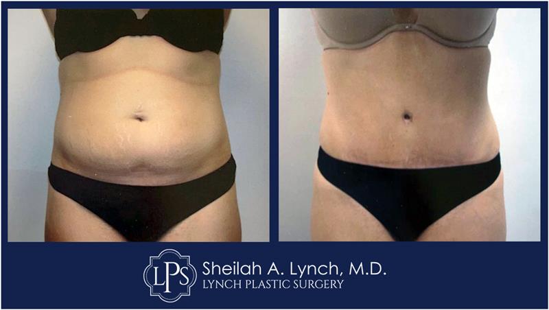 $500 Tummy Tuck Surgery Chevy Chase Patient 18 Before and After Images