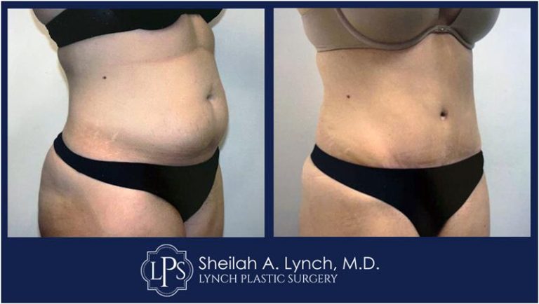 $500 Tummy Tuck Surgery Chevy Chase Patient 18 Before and After Images