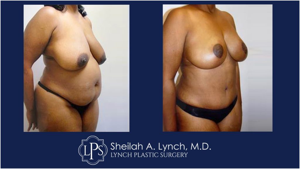Mommy Makeover Patient 5 Before and After Photo Gallery
