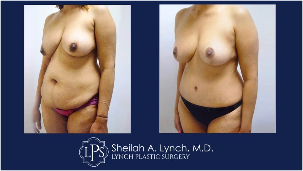 Mommy Makeover Patient 6 Before and After Photo Gallery