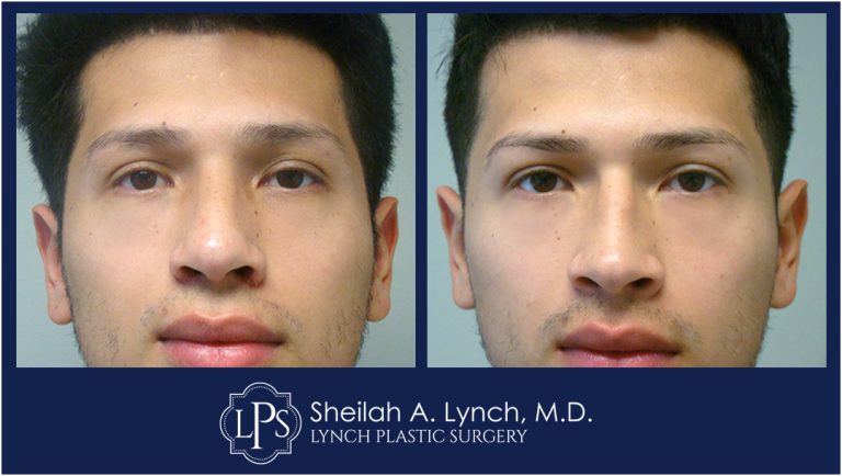 Male Rhinoplasty Before and After Images - Rhinoplasty Photo Gallery