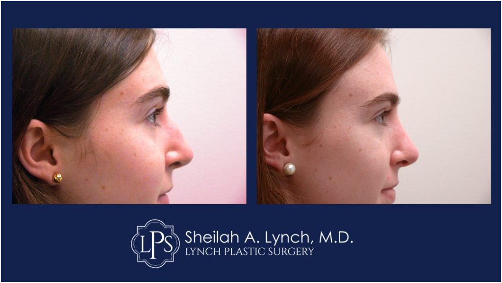 Rhinoplasty Patient 7 Nose Reshaping Before After Chevy Chase Maryland Plastic Surgeon Easton Maryland