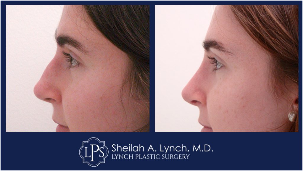 Rhinoplasty Patient 7 Nose Reshaping Before After Chevy Chase Maryland Plastic Surgeon Easton Maryland