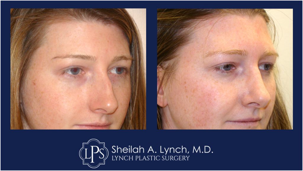Rhinoplasty Patient 4 Nose Reshaping Before After Chevy Chase Maryland Plastic Surgeon Easton Maryland