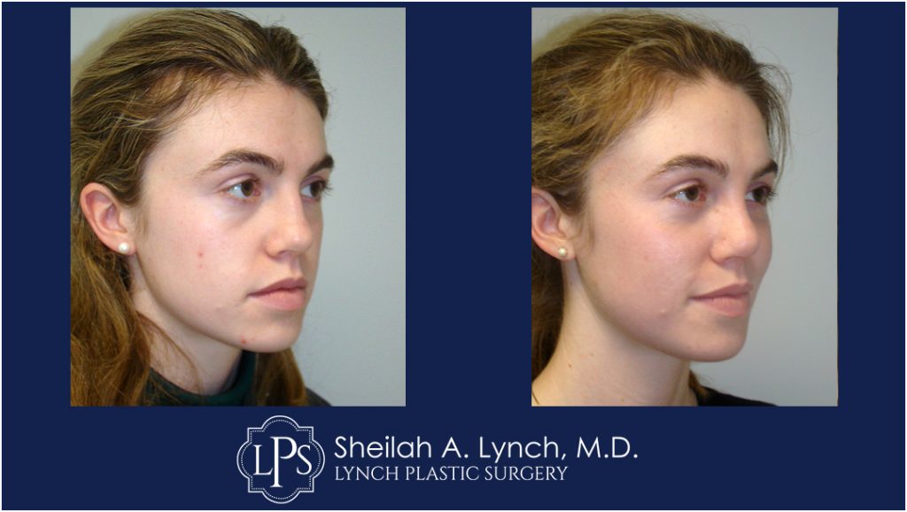 Rhinoplasty patient 6 Nose Reshaping Before After Chevy Chase Maryland Plastic Surgeon Easton Maryland