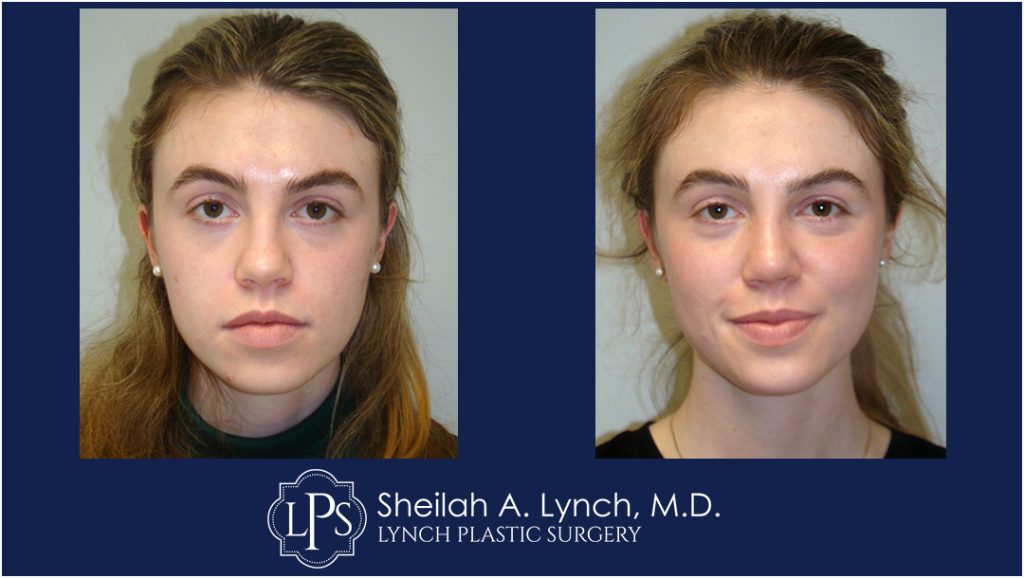 Rhinoplasty patient 6 Nose Reshaping Before After Chevy Chase Maryland Plastic Surgeon Easton Maryland