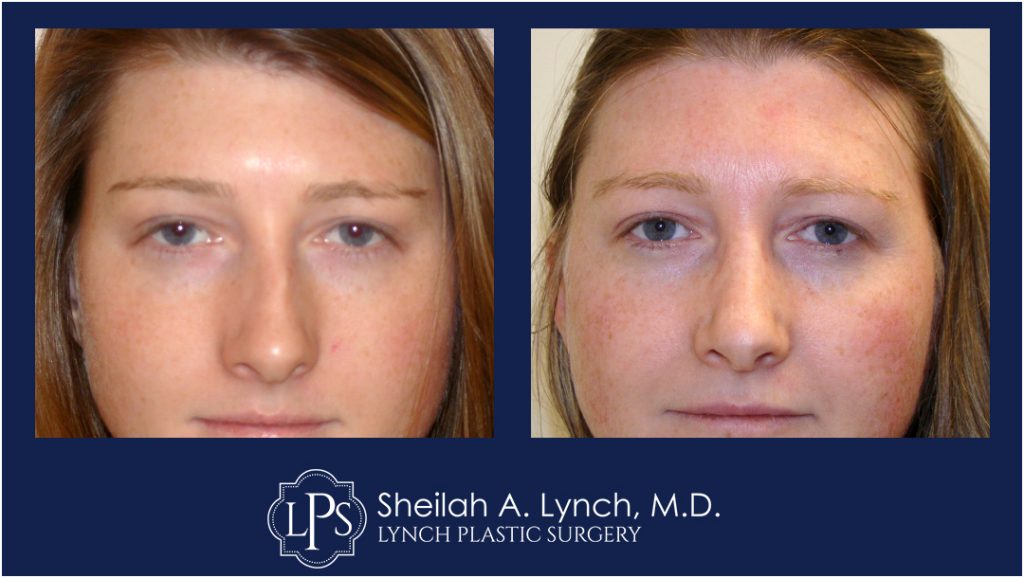Rhinoplasty Patient 4 Nose Reshaping Before After Chevy Chase Maryland Plastic Surgeon Easton Maryland