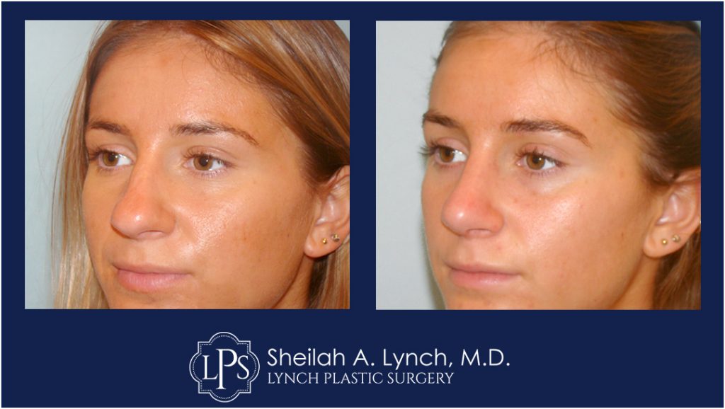 Rhinoplasty Patient 3 Nose Reshaping Before After Chevy Chase Maryland Plastic Surgeon Easton Maryland