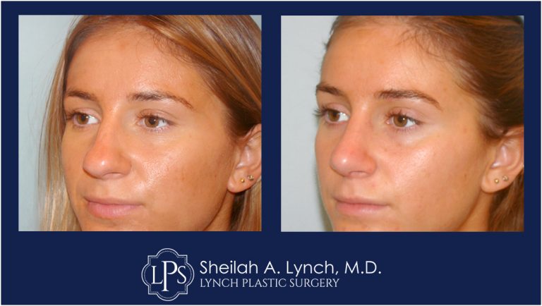 Rhinoplasty Patient 3 Nose Reshaping Before After Chevy Chase Maryland Plastic Surgeon Easton Maryland