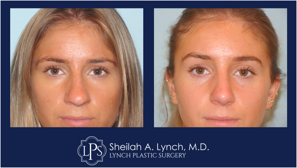 Rhinoplasty Patient 3 Nose Reshaping Before After Chevy Chase Maryland Plastic Surgeon Easton Maryland