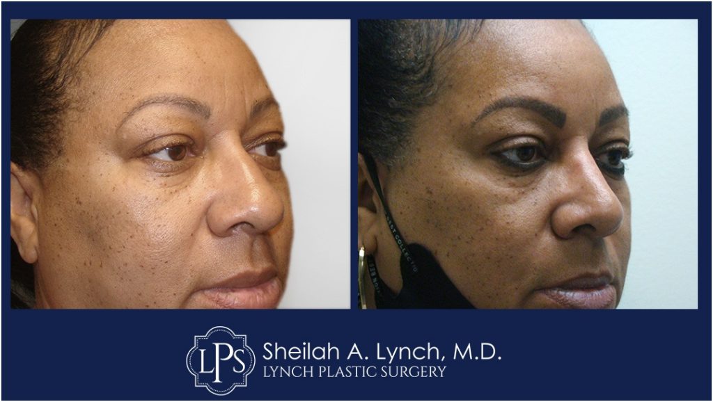 Rhinoplasty Patient 10 Nose Reshaping Before After Chevy Chase Maryland Plastic Surgeon Easton Maryland