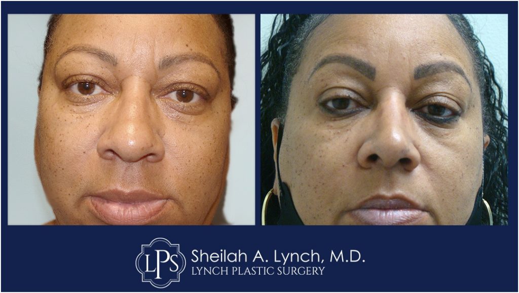 Rhinoplasty Patient 10 Nose Reshaping Before After Chevy Chase Maryland Plastic Surgeon Easton Maryland