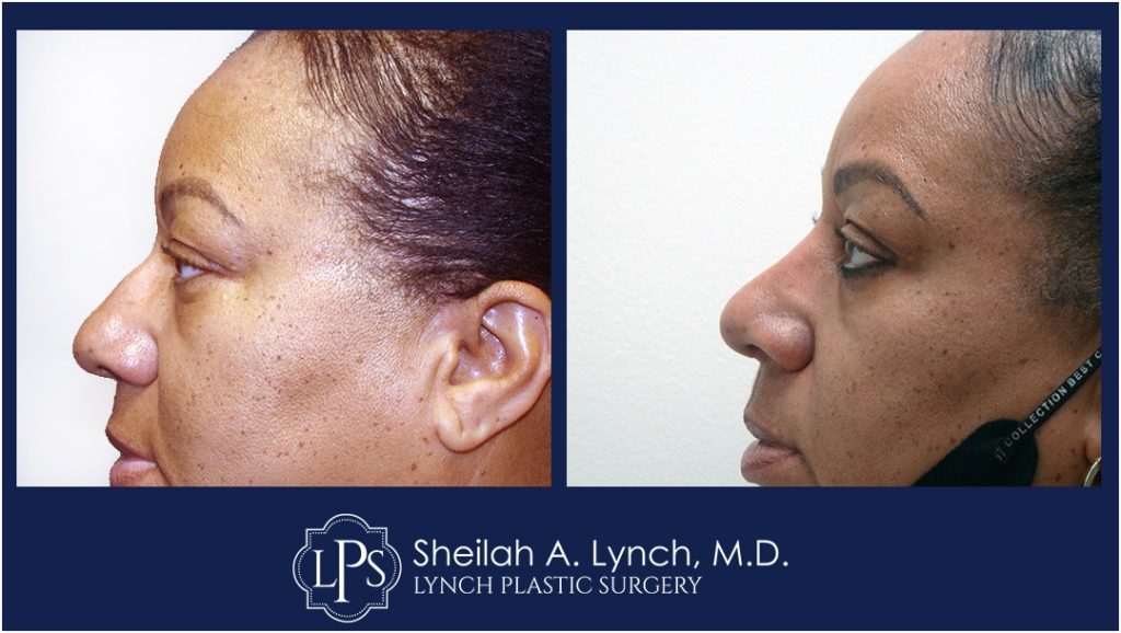 Rhinoplasty Patient 10 Nose Reshaping Before After Chevy Chase Maryland Plastic Surgeon Easton Maryland