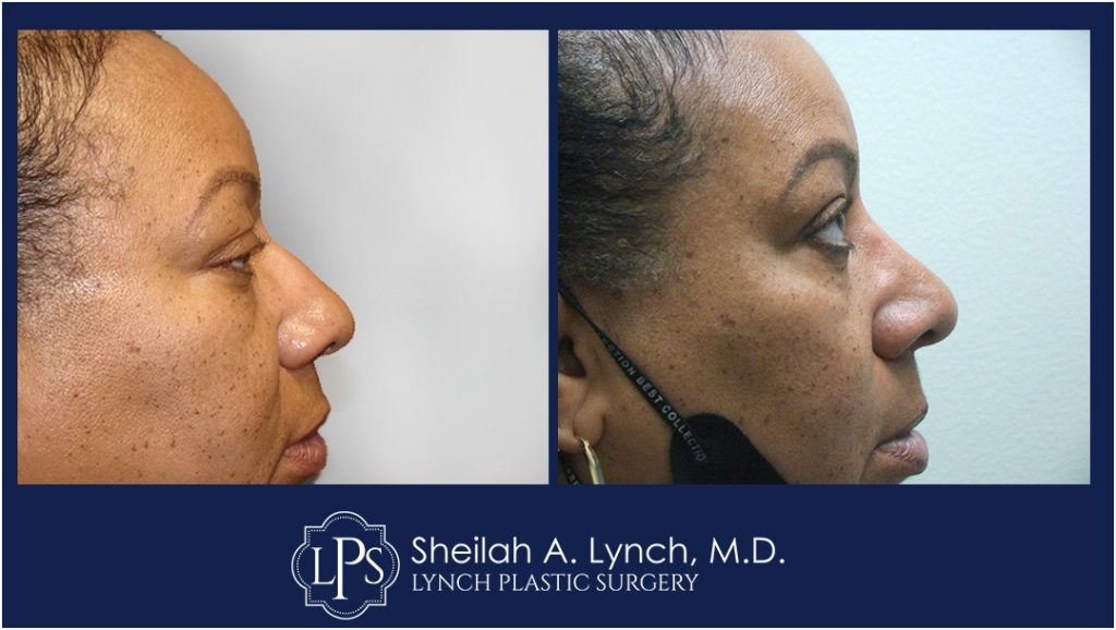 Rhinoplasty Patient 10 Nose Reshaping Before After Chevy Chase Maryland Plastic Surgeon Easton Maryland